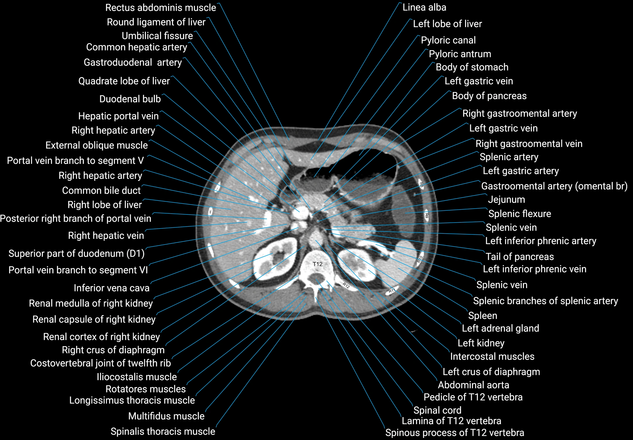 CT male pelvis axial cross sectional anatomy labelled radiology image -00045.webp
